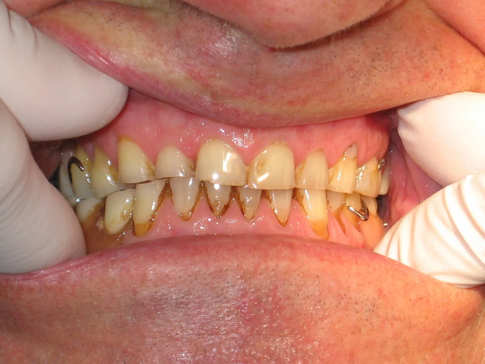 Bruksizm Objawy bruksizmu – starcie zębów i uszkodzenia szkliwa