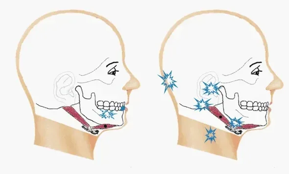Ból mięśniowo-powięziowy Punkty spustowe i ból rzutowany w mięśniu dwubrzuścowym