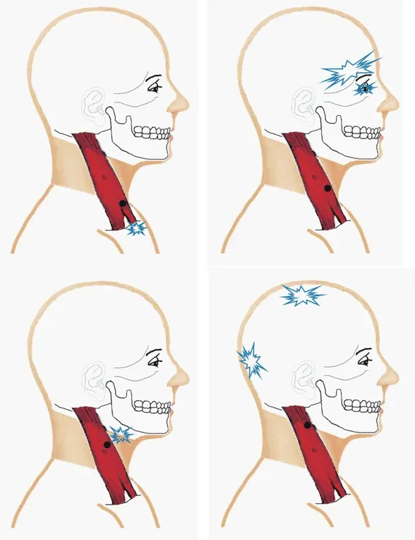 Ból mięśniowo-powięziowy Punkty spustowe i ból rzutowany w mięśniu mostkowo-obojczykowo-sutkowym