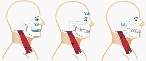Ból mięśniowo-powięziowy Punkty spustowe i ból rzutowany w mięśniu mostkowo-obojczykowo-sutkowym